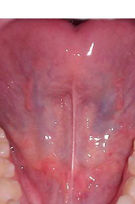 hsv 1 tongue