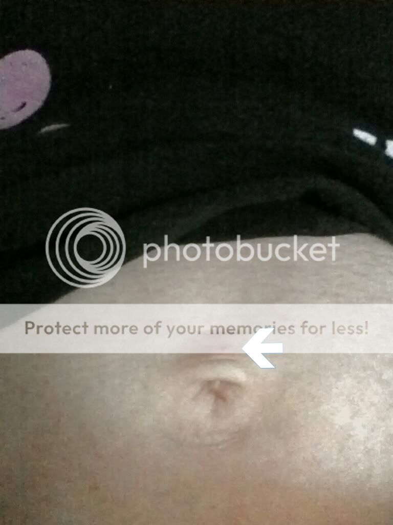 Weird Blood Spot Above Belly Button Pic Babycenter